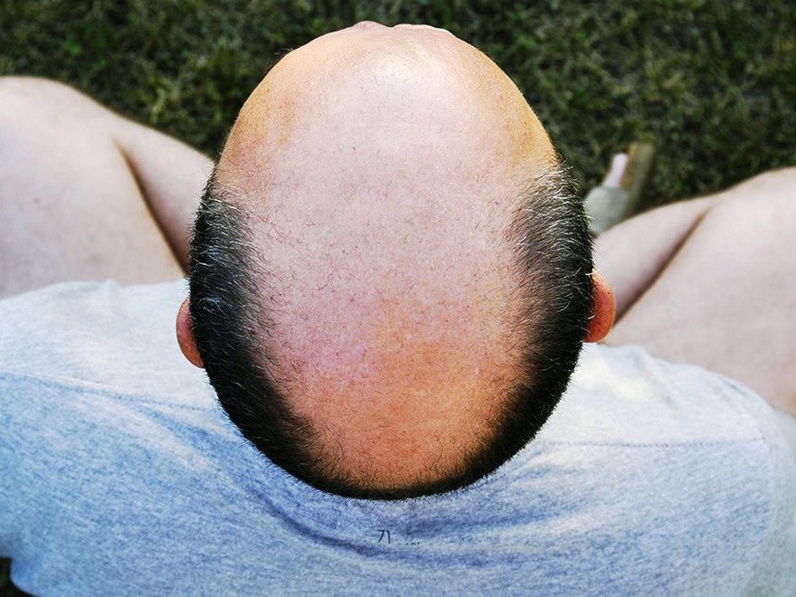  7 Methods to Cease Hair Loss In Its Tracks